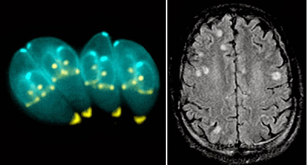 Left: Four T. gondii protozoa. Right: The cysts they produce in the brain.